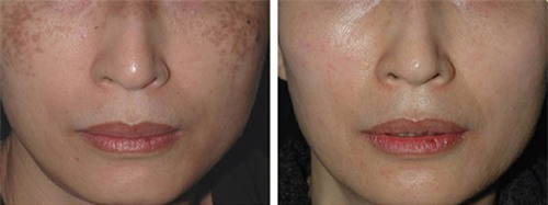 1 qua trung ga tuoi va 2 xoa mo tan nhang, lam trang da hieu qua - 1