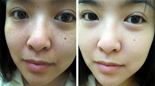 1 qua trung ga tuoi va 2 xoa mo tan nhang, lam trang da hieu qua - 5