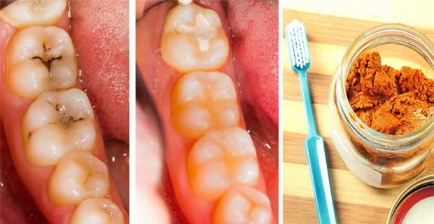 Thấy răng chớm có chấm sâu, đắp liền thứ này vào sẽ khỏi ngay, răng lại còn trắng ra - Ảnh 1.