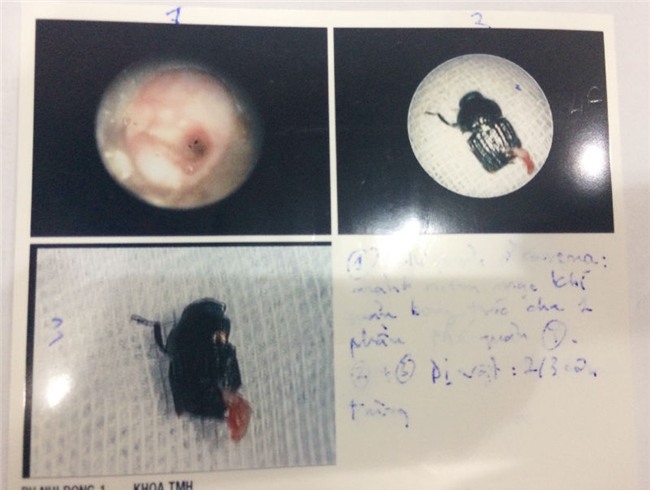 suy hô hấp, dị vật, hóc dị vật