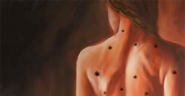 not ruoi – dau hieu bao ung thu ban can biet - 1