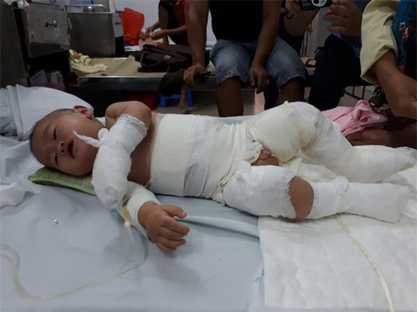 me cam diec, bo mu loa, con trai 10 thang tuoi nguy kich vi bong nang - 1