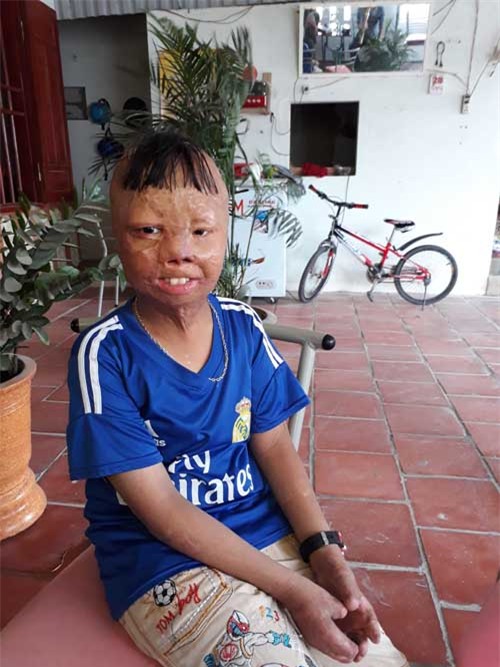 sau 6 nam, cau be bien dang vi bi cha ruot do xang dot gio ra sao? - 1