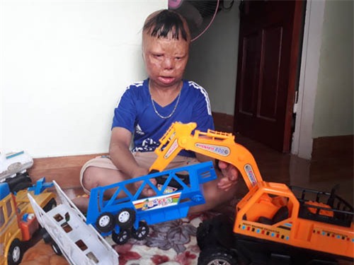 sau 6 nam, cau be bien dang vi bi cha ruot do xang dot gio ra sao? - 6