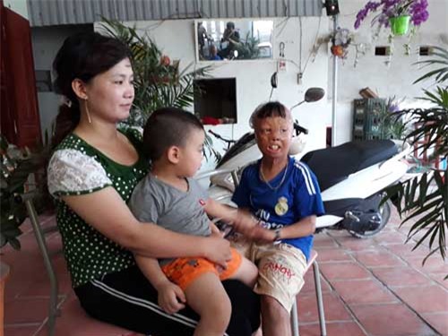 sau 6 nam, cau be bien dang vi bi cha ruot do xang dot gio ra sao? - 7