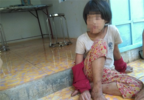 Tương lai mờ mịt của bé gái từng bị mẹ cắt gân chân - Ảnh 1.