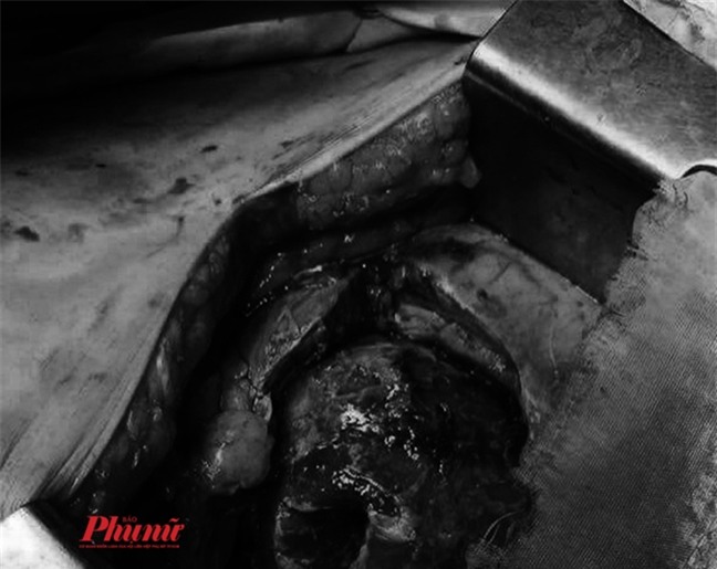 Vi khuẩn ăn gần hết quả thận của bệnh nhân 10 năm bị đái tháo đường - Ảnh 1.