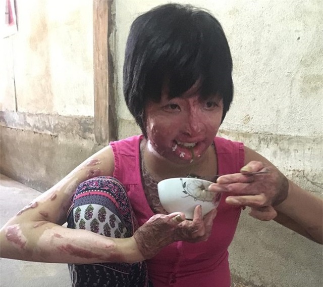 9x song sot sau khi bi chong tuoi xang dot: “da toi bi hoai tu, kho co the tu san sinh” - 1