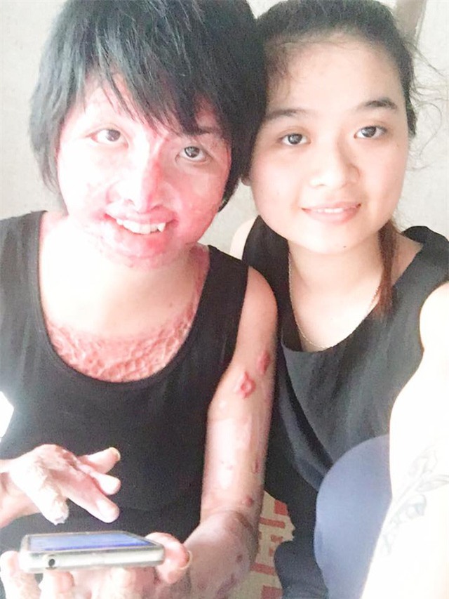 9x song sot sau khi bi chong tuoi xang dot: “da toi bi hoai tu, kho co the tu san sinh” - 3