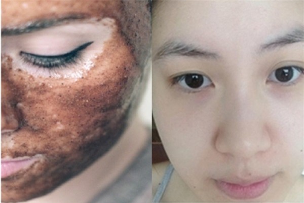 Da trang boc, sach te bao chet chi voi 1 muong duong nau