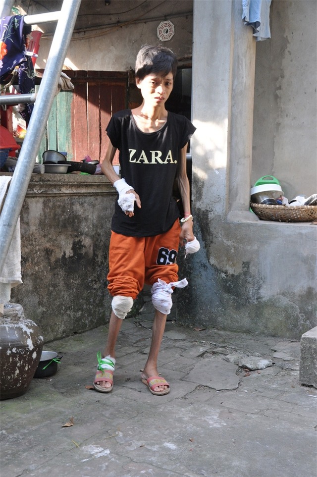 Bị bệnh viêm đa khớp đã 6 năm nay khiến cho cơ thể chị Dung bị phá hủy chỉ còn như bộ xương di động.