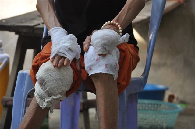 Không có tiền đi viện tiếp, chị Dung dùng cách bó lá để các khớp xương đỡ đau.