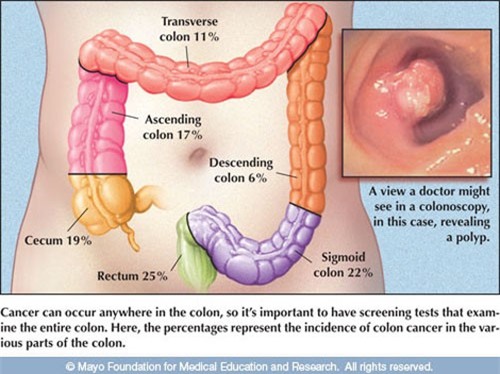 Hình ảnh ung thư đại trực tràng
