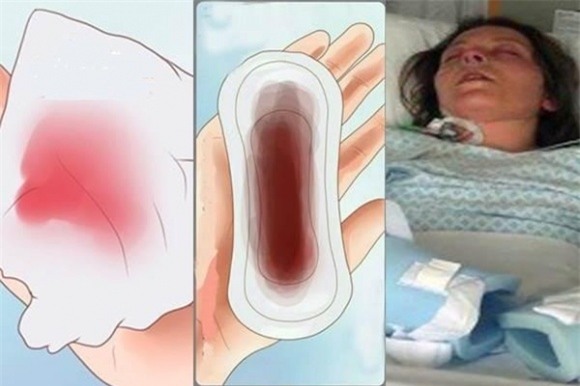 băng vệ sinh, sử dụng băng vệ sinh sai cách, sử dụng băng vệ sinh, kinh nguyệt