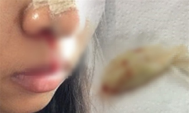 Cô gái suýt tắc thở vì bác sĩ thẩm mỹ quên lấy băng gạc trong mũi bệnh nhân - Ảnh 1.