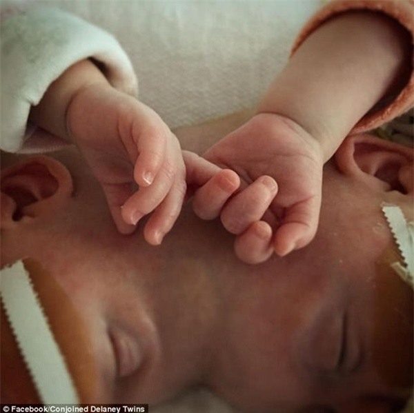 buc anh cap song sinh dinh lien dau tay nam chat tay khien nghin nguoi xuc dong - 3