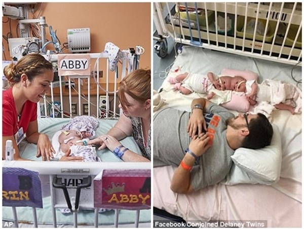 buc anh cap song sinh dinh lien dau tay nam chat tay khien nghin nguoi xuc dong - 4