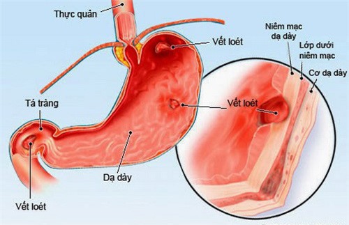  Dạ dày của trẻ có thể bị viêm loét do nhiều nguyên nhân 