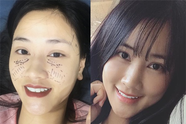 Sau 22 ngày phẫu thuật thẩm mỹ, khuôn mặt Maya khiến nhiều người không nhận ra - Ảnh 4.