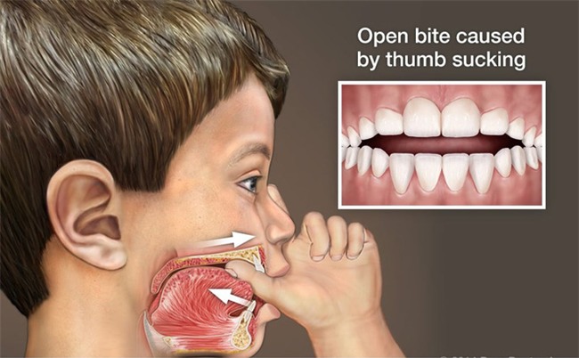 2 thói quen xấu hại trẻ cả đời nhưng nhiều mẹ vẫn dung túng để con làm - Ảnh 2.