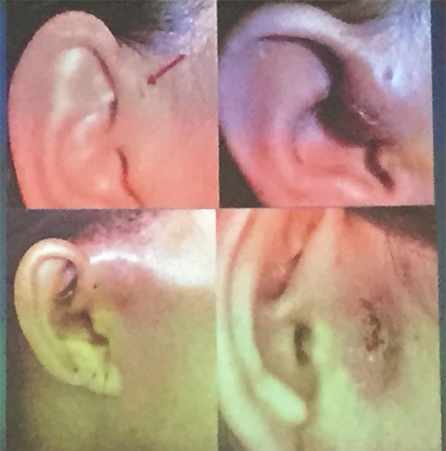 Mo lay tam nam trong tai benh nhan hon mot nam hinh anh 1