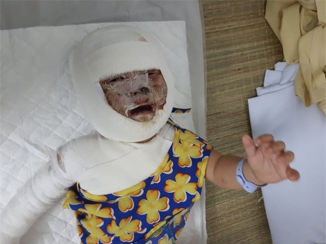 Khuôn mặt bé cháy xém, biến dạng. Ảnh PT