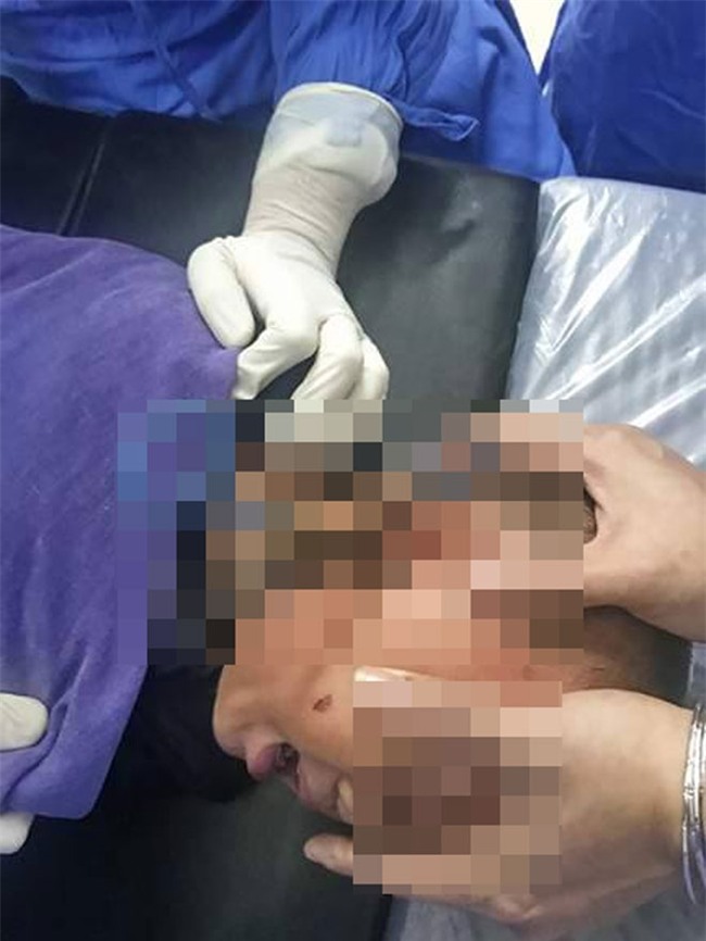 Cha mẹ lơ đễnh, bé trai 2 tuổi bị chiếc kéo cắm ngập tai - 1