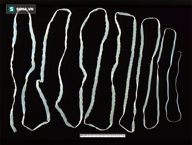 Sán dây dài 2,6 mét ngọ nguậy trong bụng vì ăn món nhiều người thích - Ảnh 2.