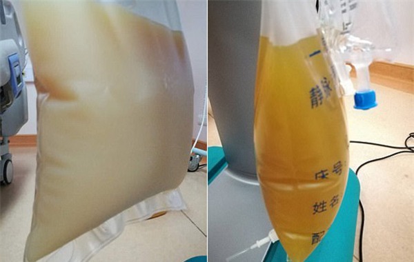 Tá hỏa với túi huyết tương như túi sữa của bệnh nhân ăn quá nhiều thịt - Ảnh 1.