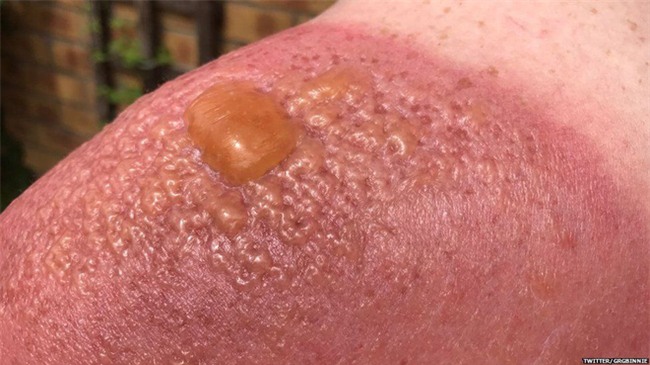 Nắng nóng kinh hoàng, chàng trai bị bỏng rộp nghiêm trọng khi làm việc ngoài trời suốt 7 tiếng - Ảnh 4.