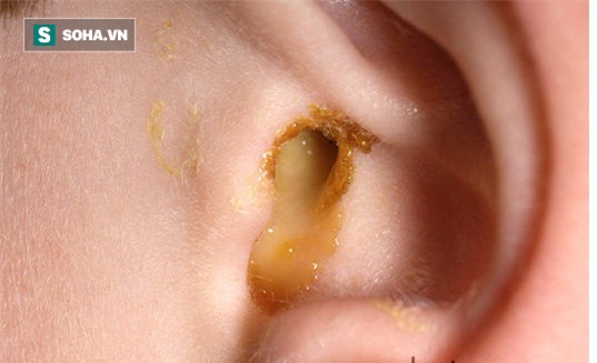 Những sai lầm của bố mẹ khi điều trị viêm tai giữa khiến con có thể bị điếc - Ảnh 2.