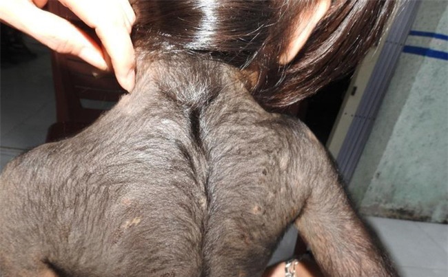 Kỳ lạ bé gái 5 tuổi mọc lông đầy mình như người sói