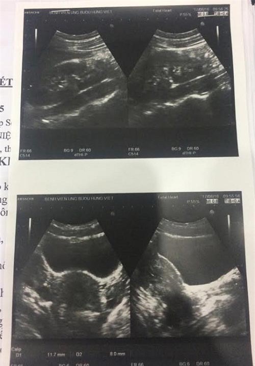 tuong bi dau bung kinh, sau khi di kham co gai 9x bat ngo phat hien minh co 3 qua than - 2