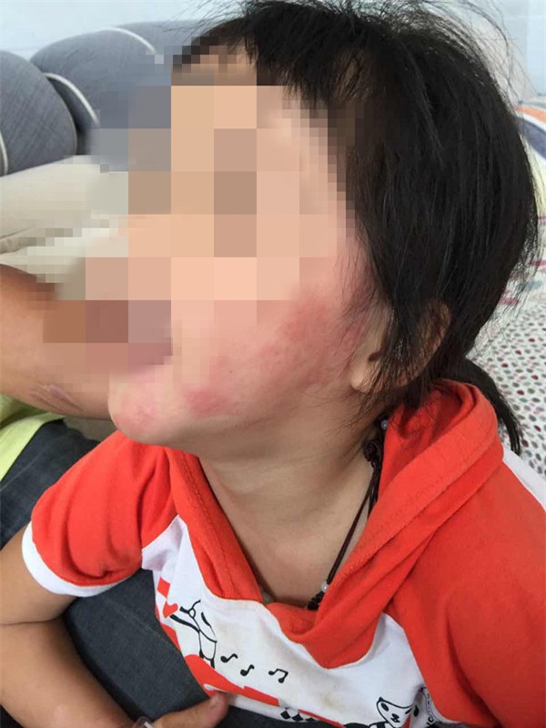 Bé gái 5 tuổi bị bỏng vì điện thoại phát nổ trong lúc ngủ, công ty điện thoại phớt lờ - Ảnh 2.