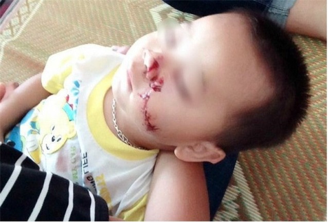 Sức khỏe cháu bé hiện đã ổn định.