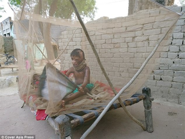 Bố tạt axit đánh ghen với mẹ, bé gái 4 tuổi trở thành nạn nhân đáng thương nhất với khuôn mặt hoàn toàn biến dạng - Ảnh 2.