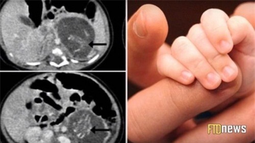 su that phia sau cau chuyen be gai vua sinh ra da tro thanh “me” - 2