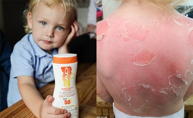 Dùng kem chống nắng SPF 50 đi dã ngoại, bé trai 3 tuổi bị cháy nắng và phồng rộp nghiêm trọng - Ảnh 1.