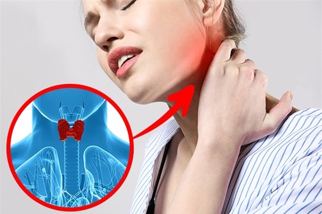 7 triệu chứng của bệnh tuyến giáp bạn không được bỏ qua - Ảnh 8.