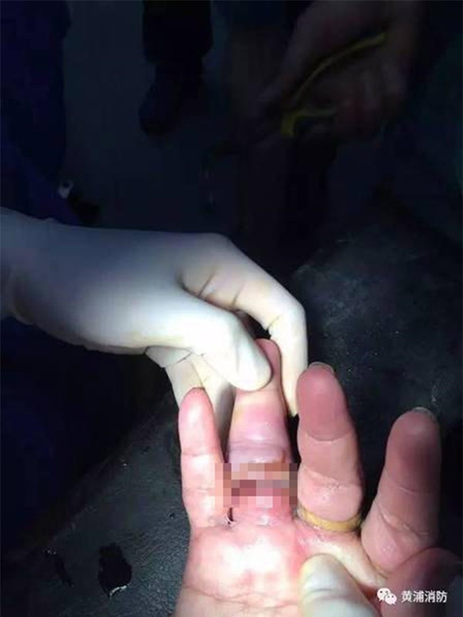 Đeo nhẫn đủ 10 ngón tay, người phụ nữ thích khoe của khóc tu tu gọi đội cứu hộ vì không tháo ra được - Ảnh 3.