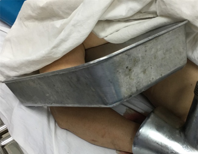 Mang ban tay bi ket trong may xay thit toi benh vien hinh anh 1