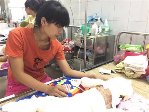 be gai 2 tuoi bong toan than, phau thuat 4 lan/thang vi hoa chat thong cong dinh vao nguoi - 1