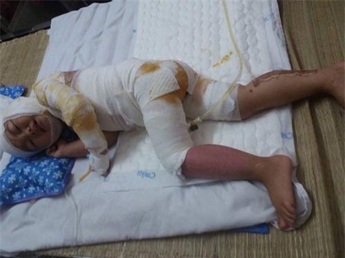 be gai 2 tuoi bong toan than, phau thuat 4 lan/thang vi hoa chat thong cong dinh vao nguoi - 2