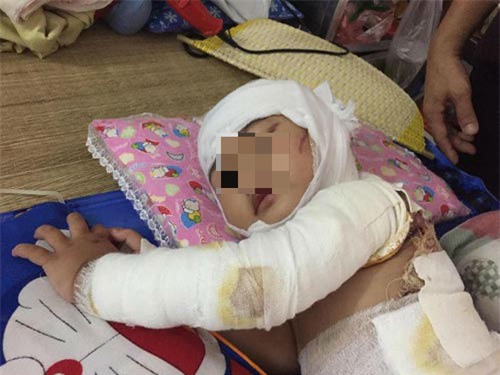 be gai 2 tuoi bong toan than, phau thuat 4 lan/thang vi hoa chat thong cong dinh vao nguoi - 3