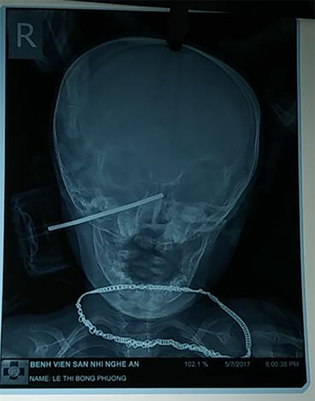 Kinh hãi hình ảnh bánh xe đồ chơi nhọn cắm sâu vào đầu bé gái 11 tháng tuổi - Ảnh 3.