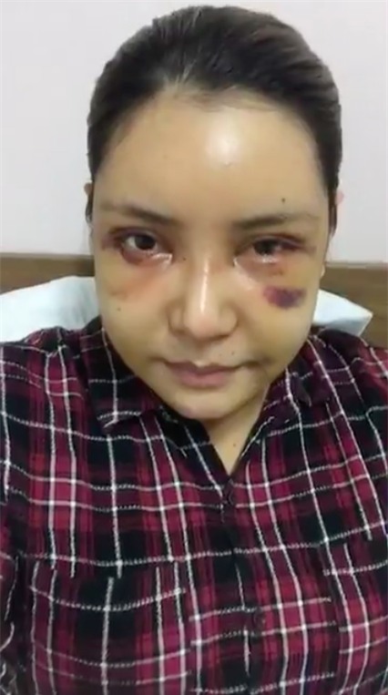 Hậu đập mặt xây lại, học trò Đàm Vĩnh Hưng vui vẻ livestream, lộ gương mặt tụ máu bầm dập - Ảnh 2.