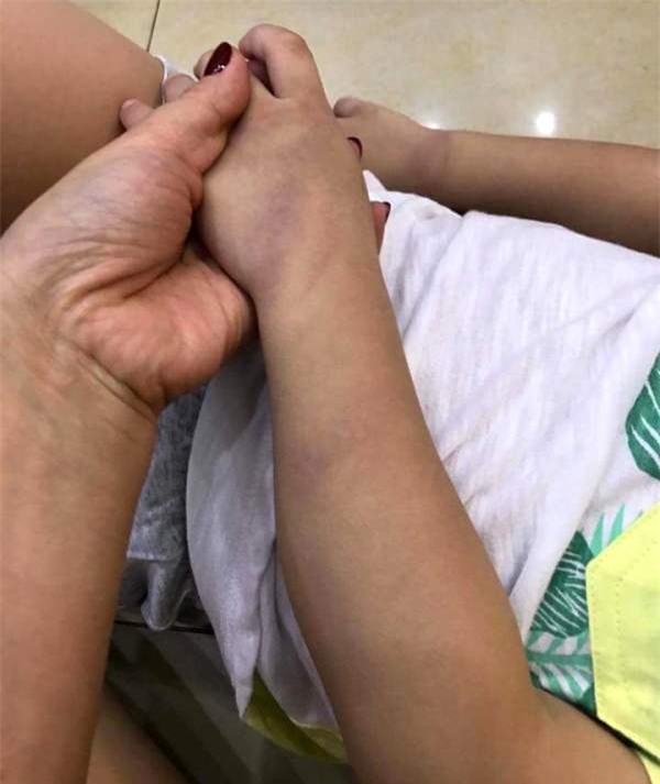 
Hình ảnh cháu K. bị cô Trang đánh bầm tím vào tay. Ảnh: Facebook
