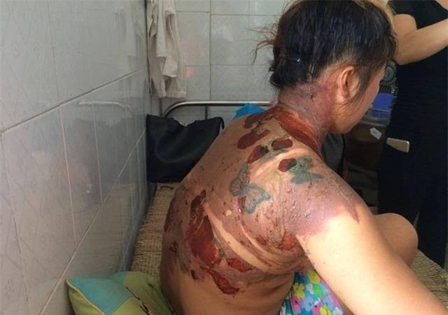 tưới nước sôi vào vợ, bỏng