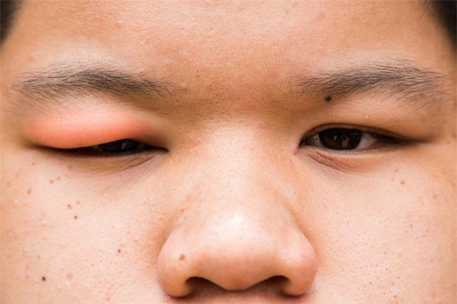 Lẹo mắt là một loại nhiễm trùng có thể gây sưng mi mắt.