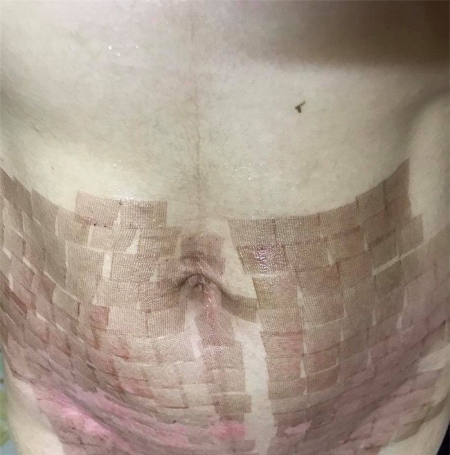 Chi 15 triệu làm đẹp sau sinh ở spa, mẹ trẻ bị bắn laser chín thịt, bụng bỏng rộp, sẹo chi chít - Ảnh 2.